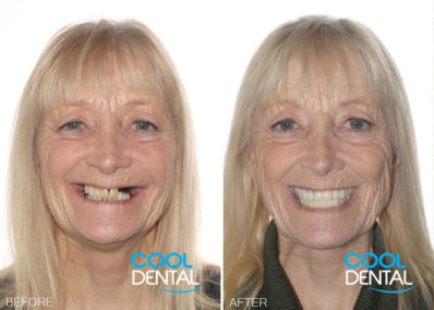 before and after photo of patient smiling 2