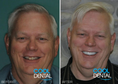 before and after photo of patient smiling 3