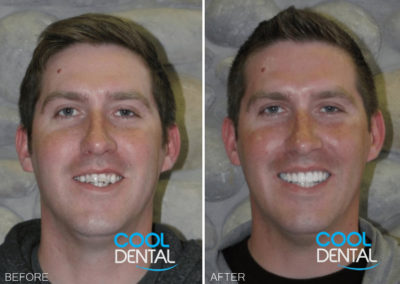 before and after photo of patient smiling 1