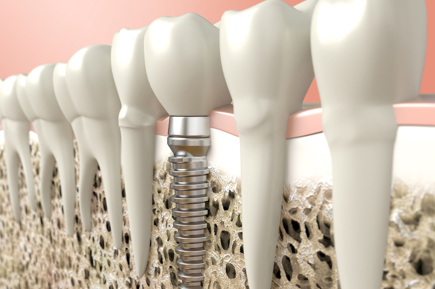 Stock Illustration of Dental Implants.