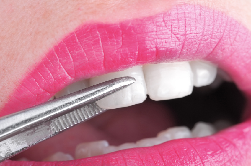 woman getting dental veneers