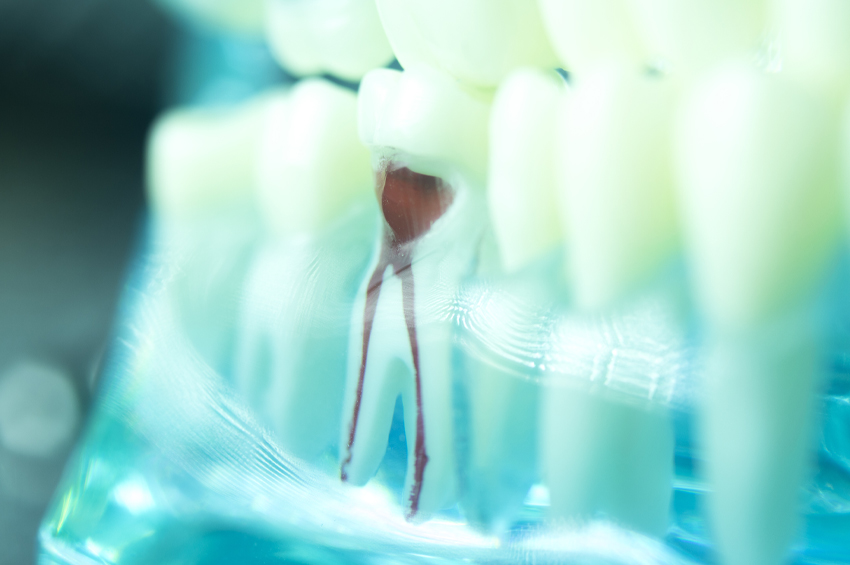 xray of root canal