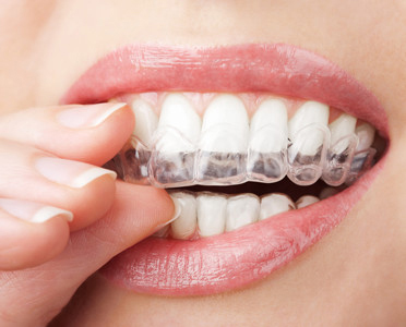 woman seen putting on her clear Invisalign braces