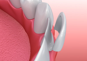 Stock Photo illustration of veneers