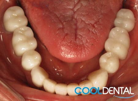 After Photo Showing Healed Pallet Damage, Properly Cleaned Teeth and Gold Crowns replaced with Ceramic White Fillings.