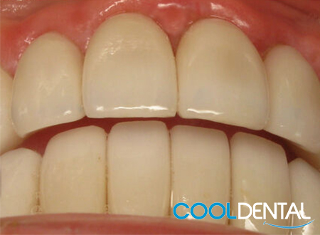 After Photo of a Smile Needing A Dental Cleaning and Cosmetic Work