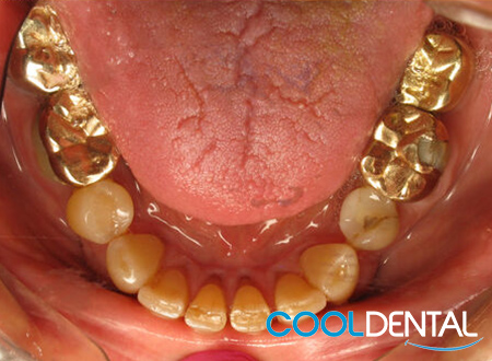 Before Photo Showing Tongue Damage, Stained Teeth and Gold Crowns.