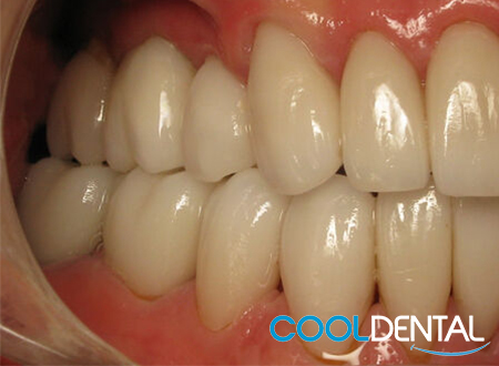 After Photo of Teeth Professionally Cleaned at Cool Dental.