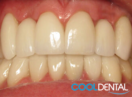 After photo of tooth alignment with Crowns.