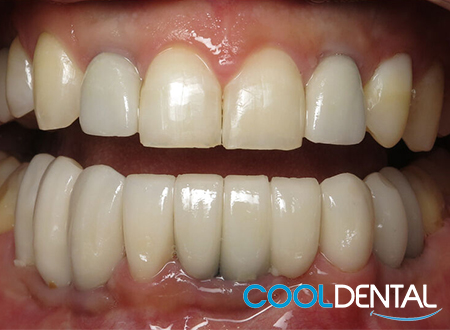 After Photo of Missing Teeth Fixed with Dental Implants and Veneers.