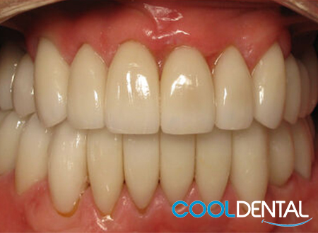 After Photos of Eroded Teeth that Needed to be Cleaned and a Crown Treatment.