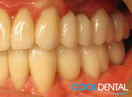 After Photo Of Polished Teeth and Golden Caps exchanged for Ceramic Crowns.