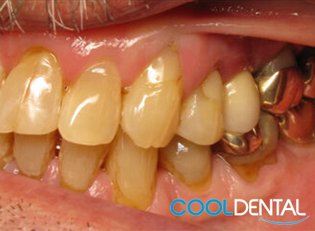 Before Photo Of Stained Teeth and Golden Caps