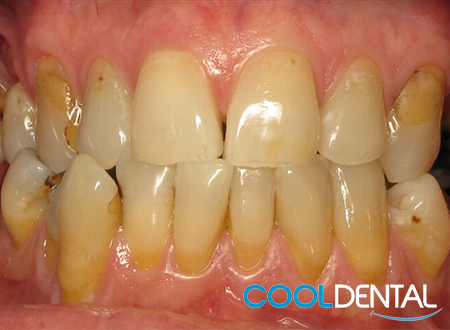 Before Photo showing Stained Teeth And Erosion of Teeth and Gum Line.