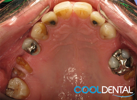 Before Photo of Metal Fillings, Various Sized Cavities and Total Tooth Erosion.