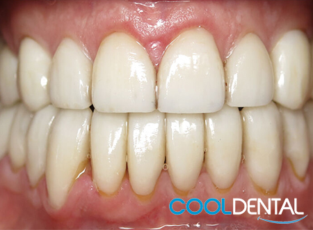 After Photo Using Veneers and Cleaning as Treatment.