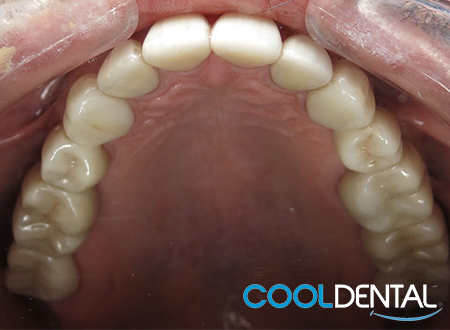 After Photo of Metal Fillings, Various Sized Cavities and Total Tooth Erosion Treated by Implants and Dental Crowns.