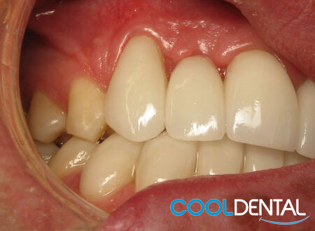Photo of teeth after Ceramic Crowns.