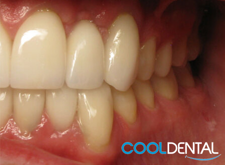 Photo of Teeth After Ceramic Crowns.