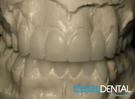 A Refined Mold of a patients teeth.