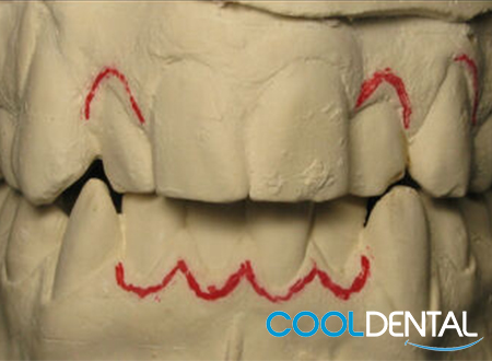 A rough dental mold with markings for potential work to be done.