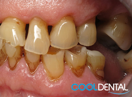 Before Pictures of extensive damage caused by a lack of Molars