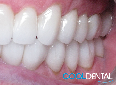 After Photo of Ceramic Crowns Used to Make Teeth Taller and More Proportional.