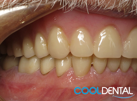After Photo of Full Denture Treatment on Top Row, Crowns on the Bottom.