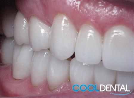 After Photo of Ceramic Crowns Used to Make Teeth Taller and More Proportional.