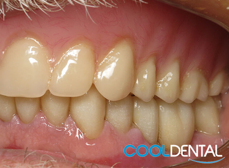 After Photo of Full Denture Treatment on Top Row, Crowns on the Bottom.