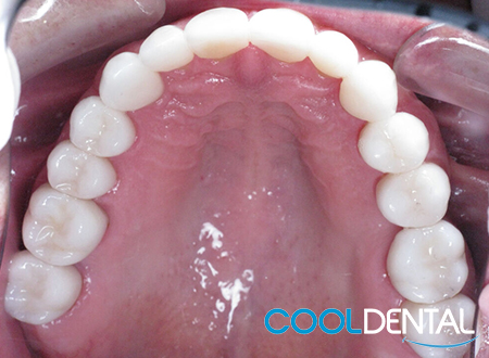 After Photo of Ceramic Crowns Used to Make Teeth Taller and More Proportional.