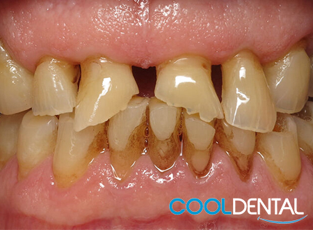 Before Pictures of extensive damage caused by a lack of Molars