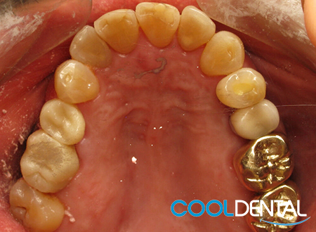 Before Photo Showing Pallet Damage, Stained Teeth and Gold Crowns.