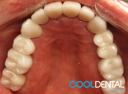 After Photo Showing Healed Pallet Damage, Properly Cleaned Teeth and Gold Crowns replaced with Ceramic White Fillings
