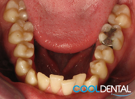 Before photo of tooth alignment and Removable of Metal Fillings