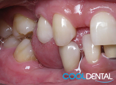 Before Photo of Patients with Gaps in Teeth Showing tongue through Gaps.