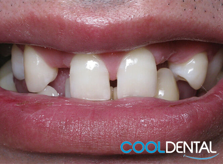 Second Set of Before Photo of Patient Smiling with Missing Teeth.