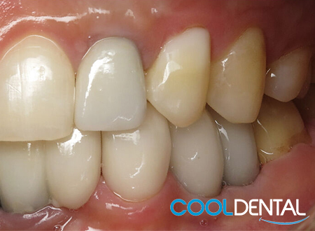 After Photo of Gaps Filled With Dental Implants.