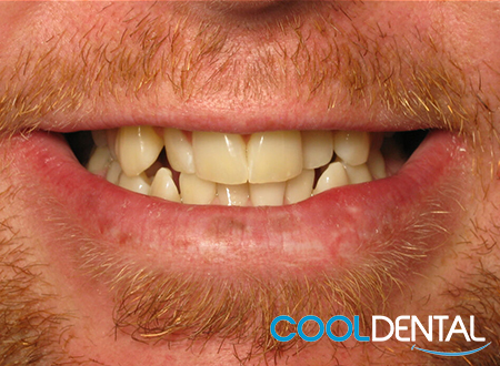 Before Photo of a patients smile.