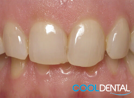 Before Photo; Patient Wanted Even Teeth and to Show Less Gum Line.