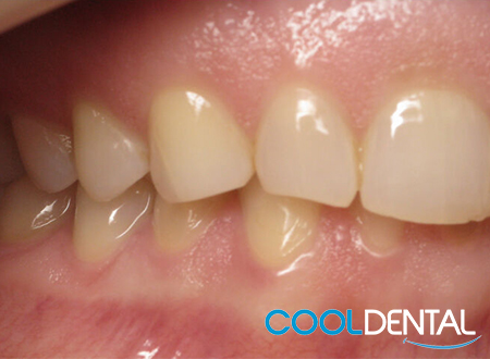 Before Photo; Patient Wanted Even Teeth and to Show Less Gum Line.