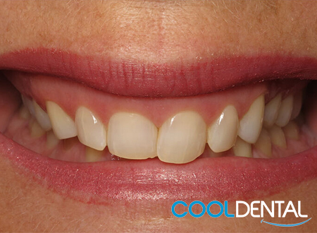 Before Photo; Patient Wanted Even Teeth and to Show Less Gum Line.