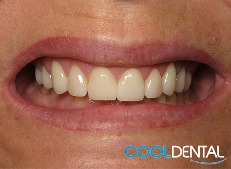 After Photo; Patient Was Treated With Ceramic Crowns and Laser Gum Reshaping.