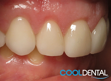 After Photo; Patient Was Treated With Ceramic Crowns and Laser Gum Reshaping.