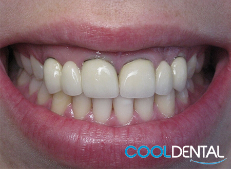 Before Photo of Preexisting Metal Bridge Work that is visible where the Teeth Meet the Gum Line.