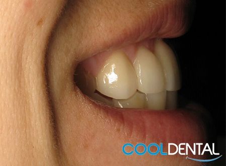 After Photo of new Ceramic Bridges From Cool Dental.