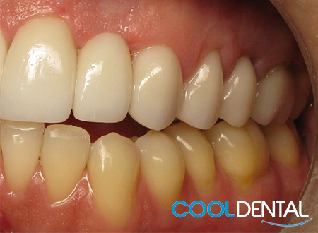 Second Set of After Photos of Misaligned Teeth Fixed With Ceramic Crowns.