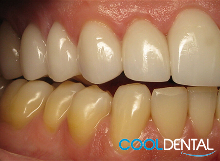 After Photo of Misaligned Teeth Fixed With Ceramic Crowns.