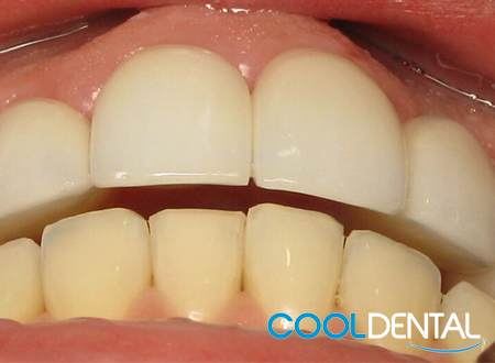 After Photo of teeth Corrected with Ceramic Crowns.
