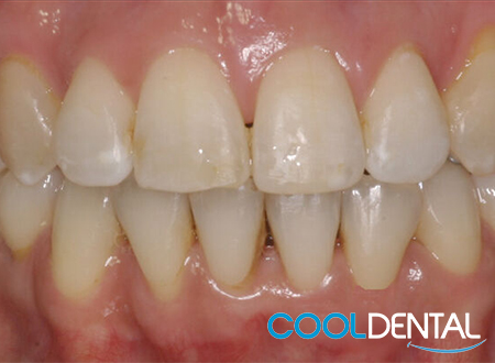 After Photo of Teeth Properly Aligned with Metal Braces.